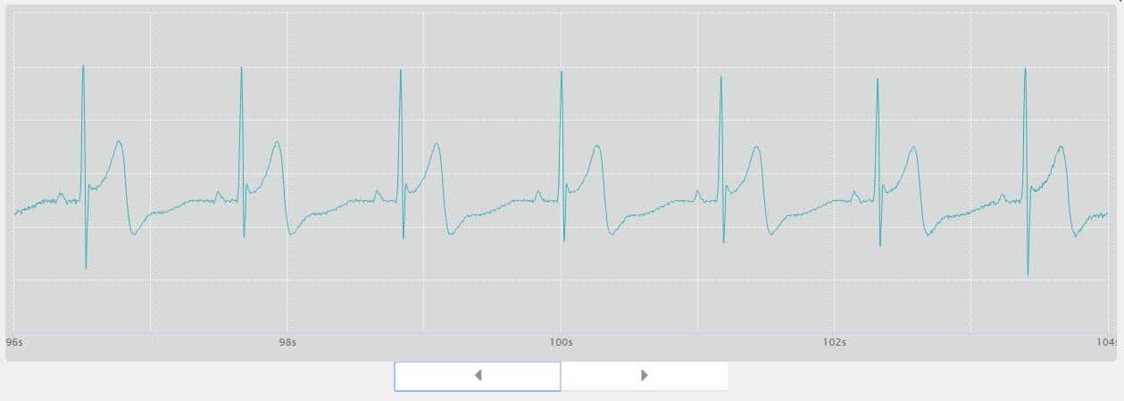EKG-Messung mit dem Vitalmonitor